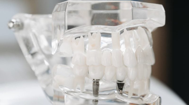 How to Identify the Right Type of Dental Implant for You