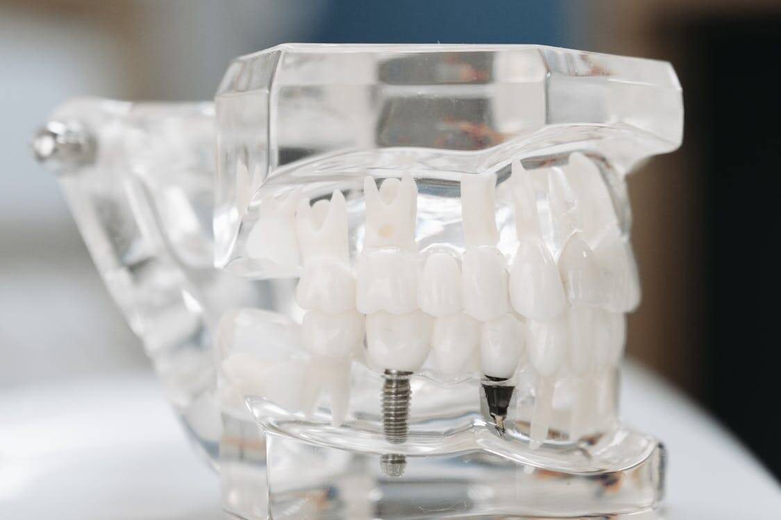 Transparent Dental Implant Model - How to Identify the Right Type of Dental Implant for You